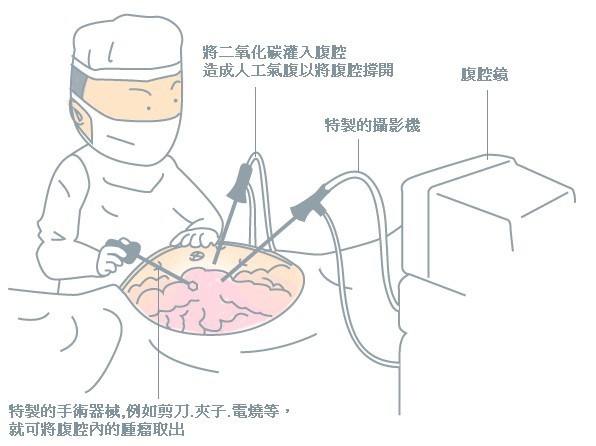 腹腔鏡手術(shù)